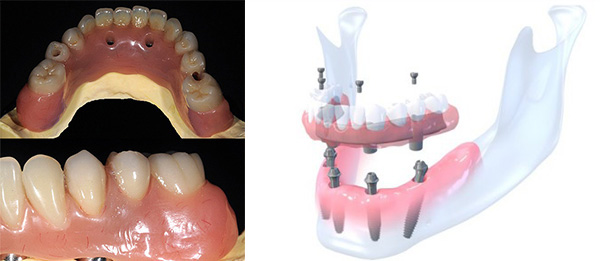 Straumann Pro Arch