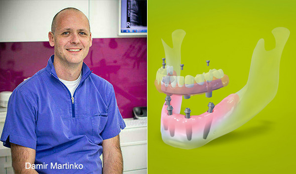 Straumann Pro Arch