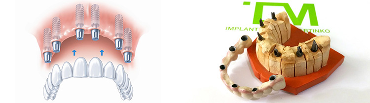 Circular bridge on implants