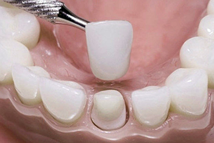 Dental crowns
