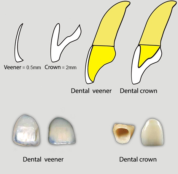 dental veneers