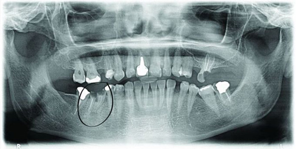 Immediate dental implants