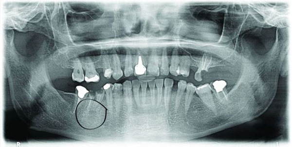 Immediate dental implants