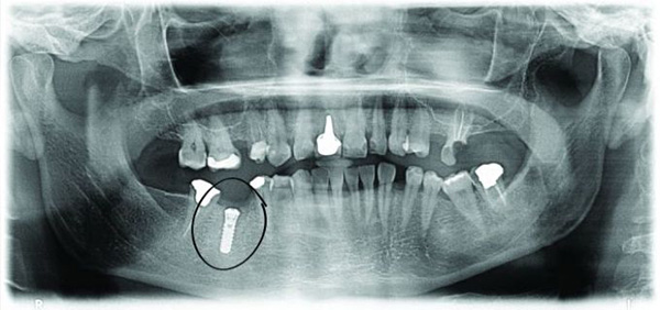 Immediate dental implants