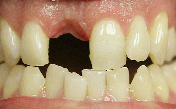 Immediate dental implants