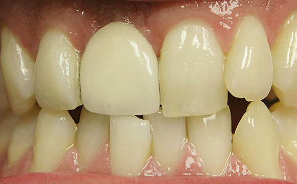 Immediate dental implants