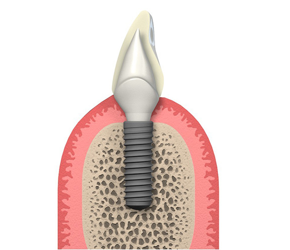 Dental implants