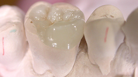 Inlay and Onlay