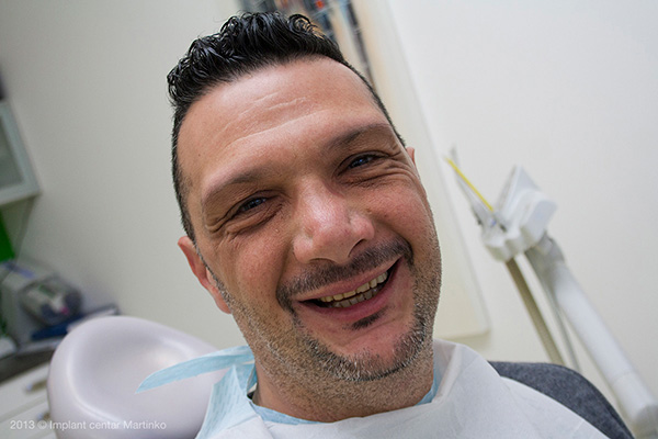 Teeth whitening