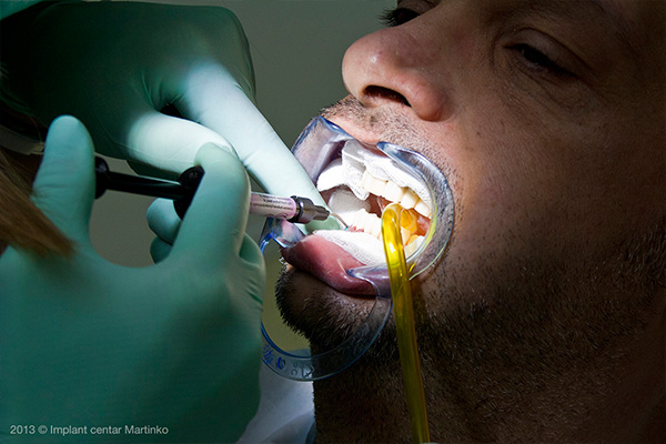 Teeth whitening