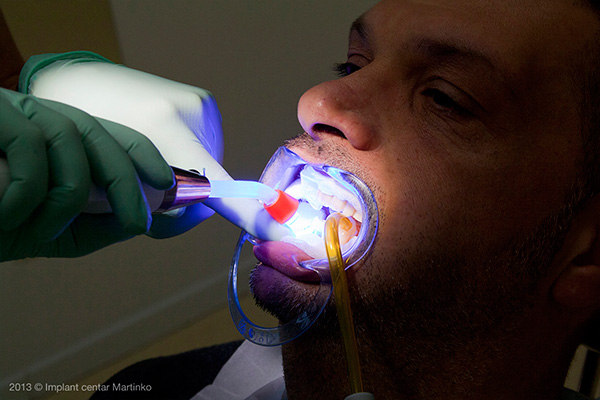Teeth whitening