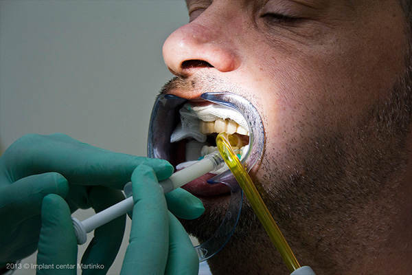 Teeth whitening