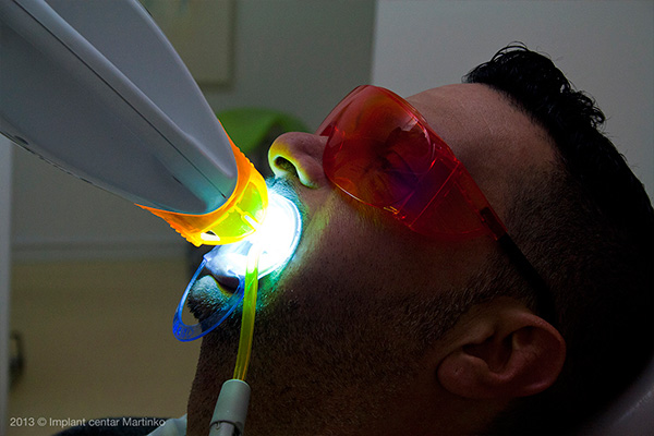 Teeth whitening
