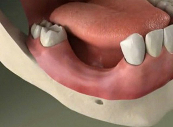 Bone augmentation