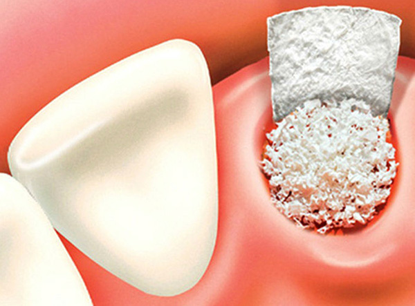 Bone augmentation