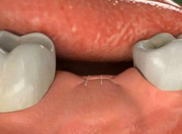 Bone augmentation