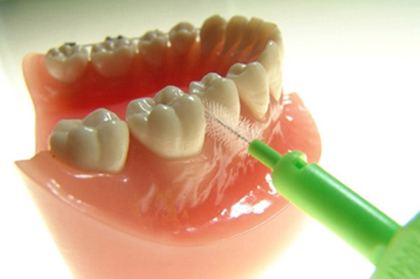 Održavanje oralne higijene kod zubnih implantata