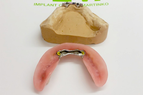 Partial dentures