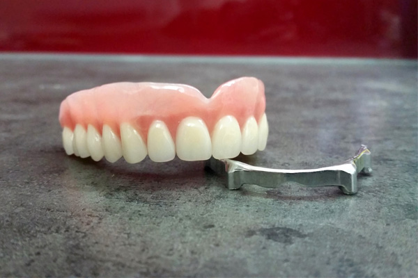 Dentures on implants