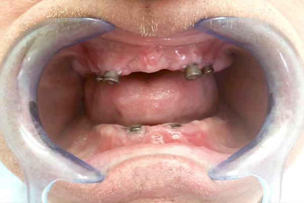 Dentures on implants