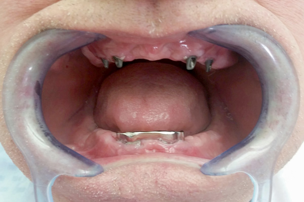Partial dentures