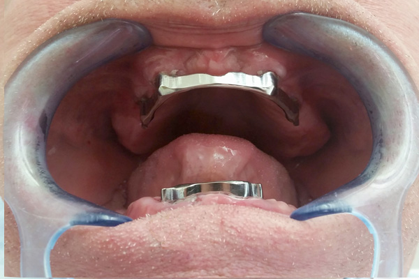 Dentures on implants
