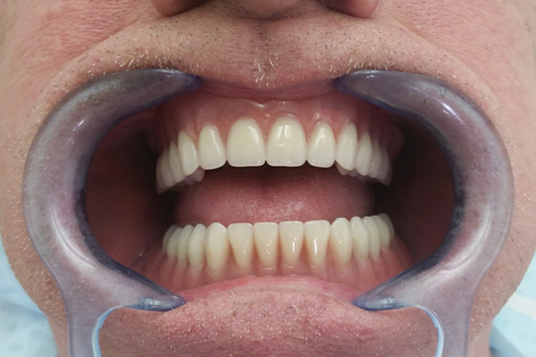 Partial dentures