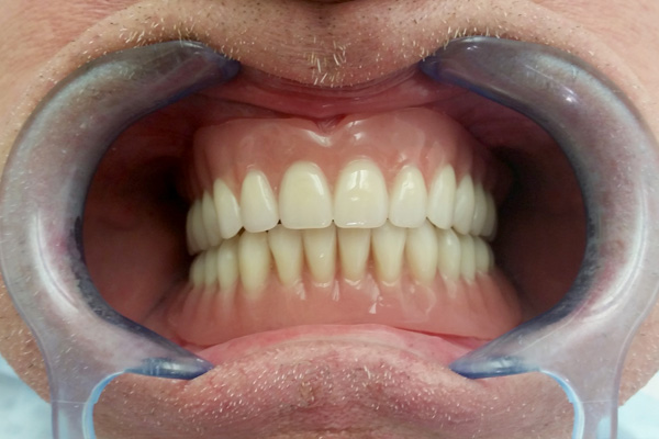 Dentures on implants