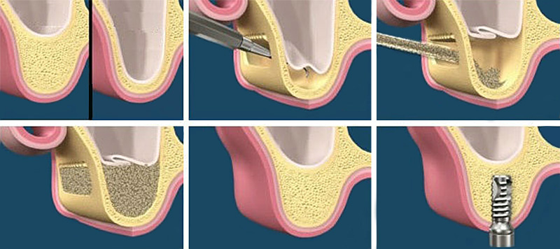 Sinus lift
