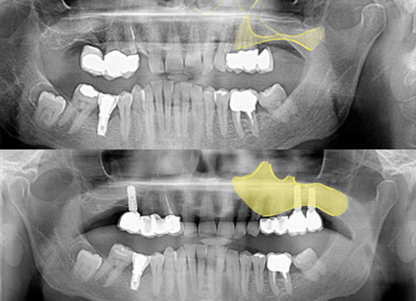 Sinus lift