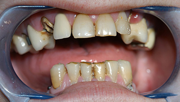 Dental crowns