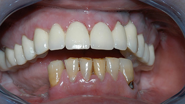 Dental crowns