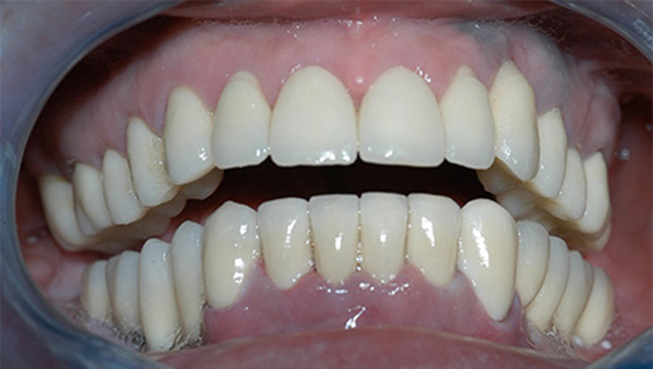 Dental crowns