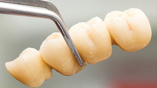 Dental crowns