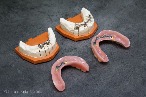 Partial dentures