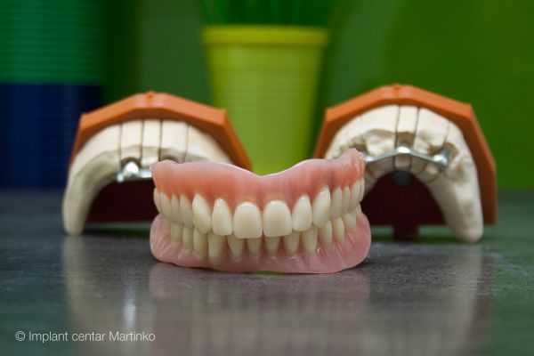 Dentures on implants