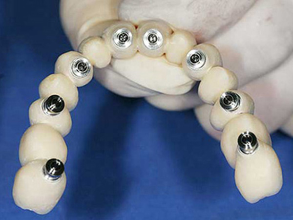 Dental bridges