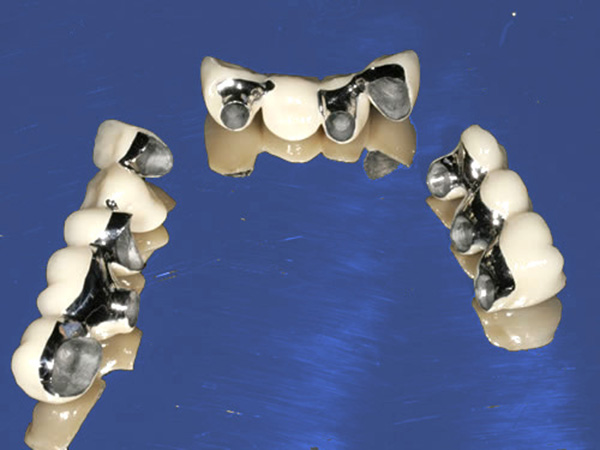 Dental bridges