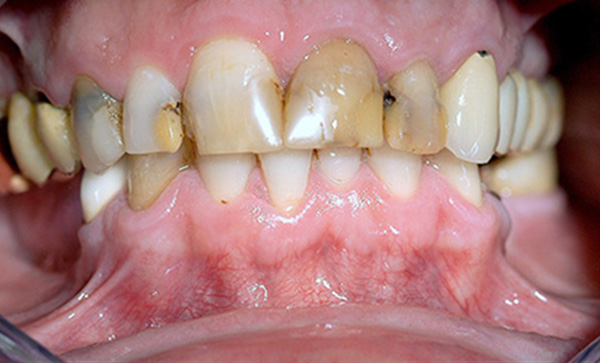 Dental bridges