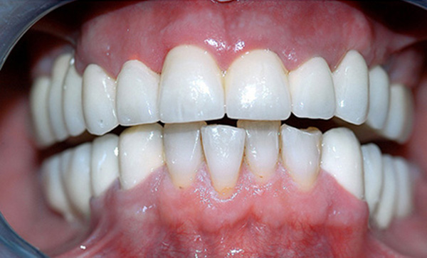 Dental bridges