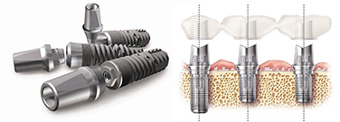 Dental implants